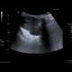 Pleomorphic adenoma, parotid gland: US - Ultrasound